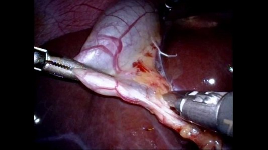 Laparoscopic Cholecystectomy